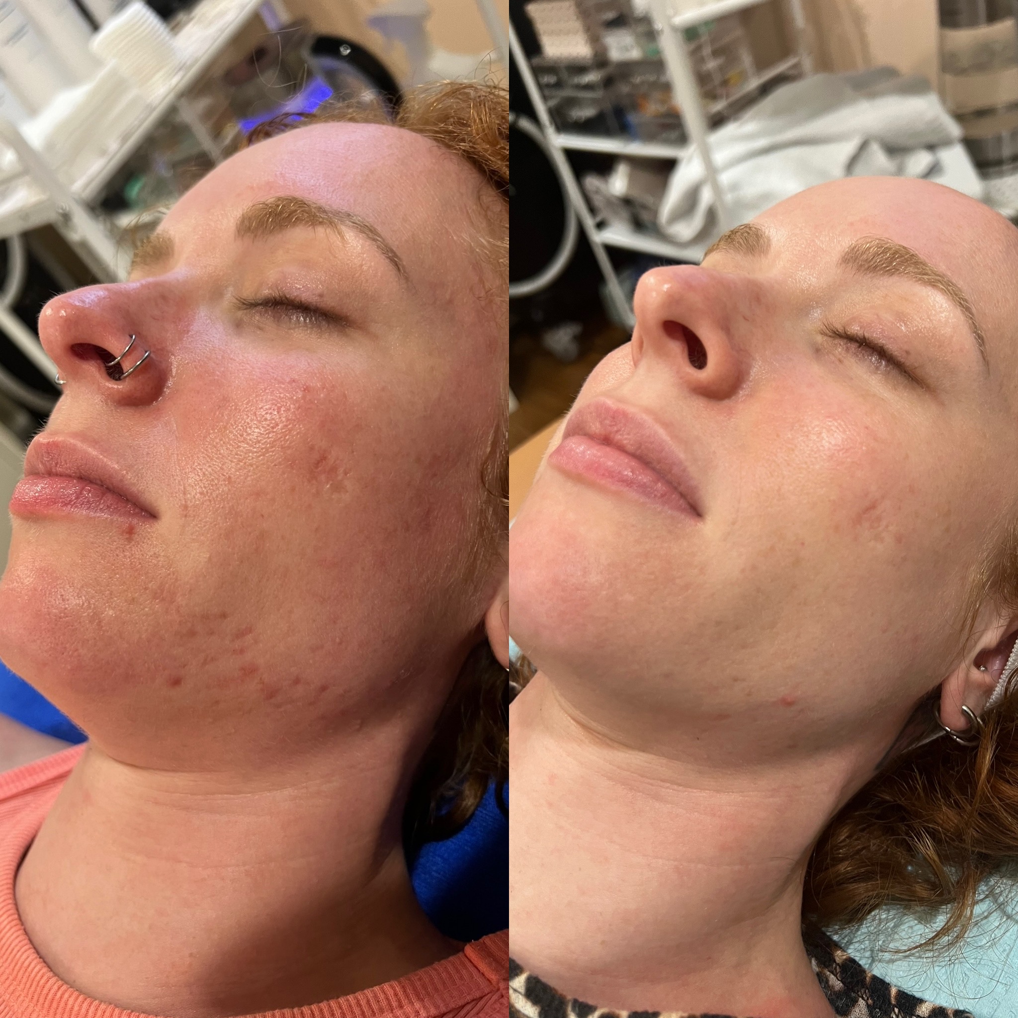 Skin transformation