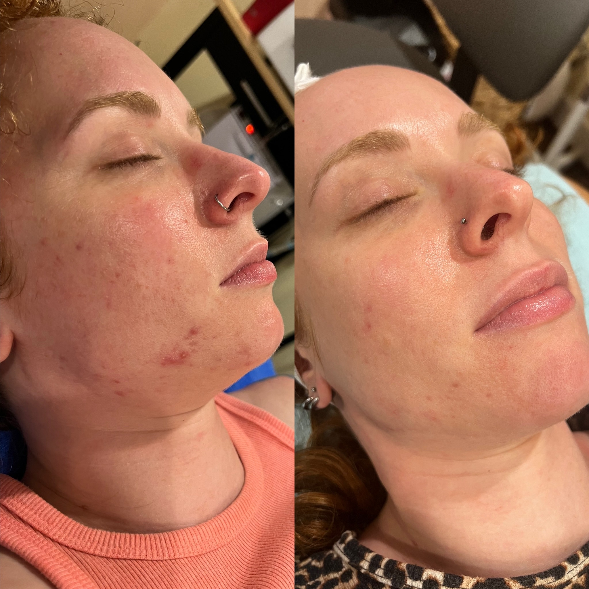 Skin transformation